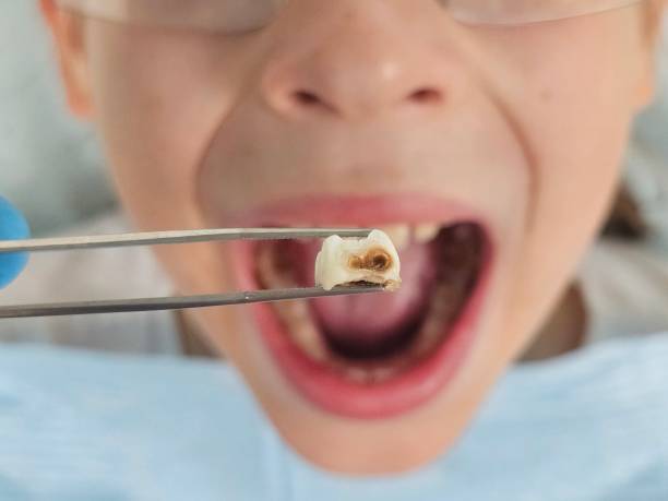 Best Knocked-Out Tooth (Avulsed Tooth) Treatment in Livingston, LA