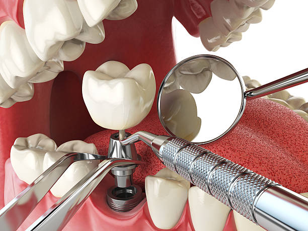 Best Emergency Dental Care for Sports Injuries in Livingston, LA